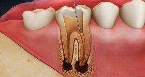 Read more about the article Viêm tủy răng