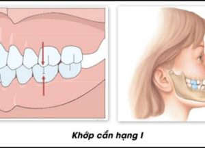 Read more about the article SAI KHỚP CẮN LOẠI I