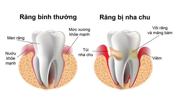 Read more about the article Túi Lợi